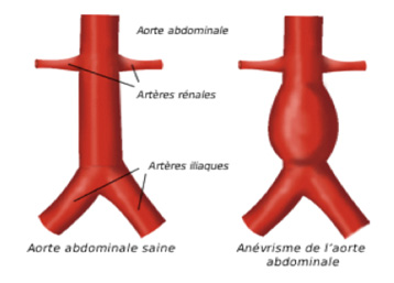 Anévrisme de l'aorte abdominale sous rénale : intérêt de l ...