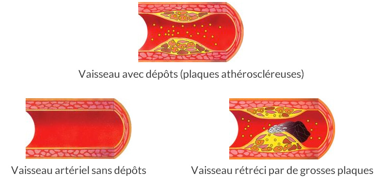 Arthérosclérose